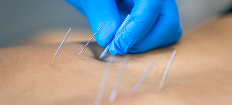 Akupunktur